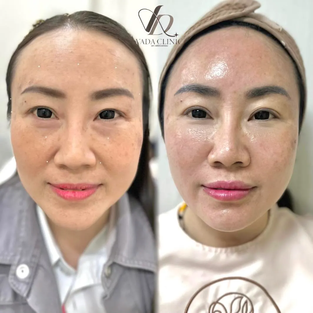 ฉีด Filler ฟิลเลอร์เติมเต็มใบหน้า ปรับรูปหน้า ผลงานจริง Vada Clinic บ้านฉาง ระยอง