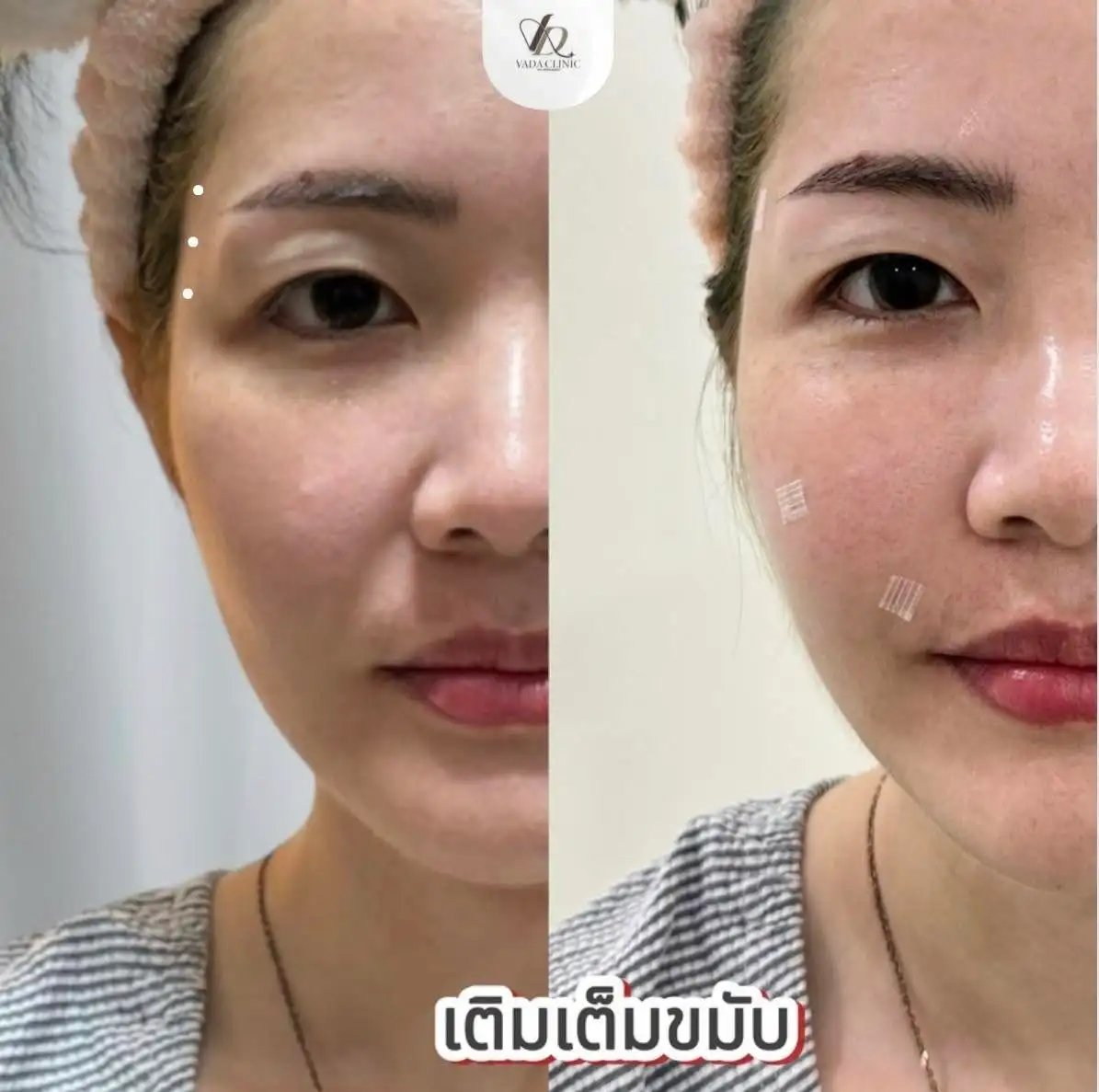 ผลงาน Before After HIFU RF ยกกระชับหน้า Vada Clinic บ้านฉาง ระยอง