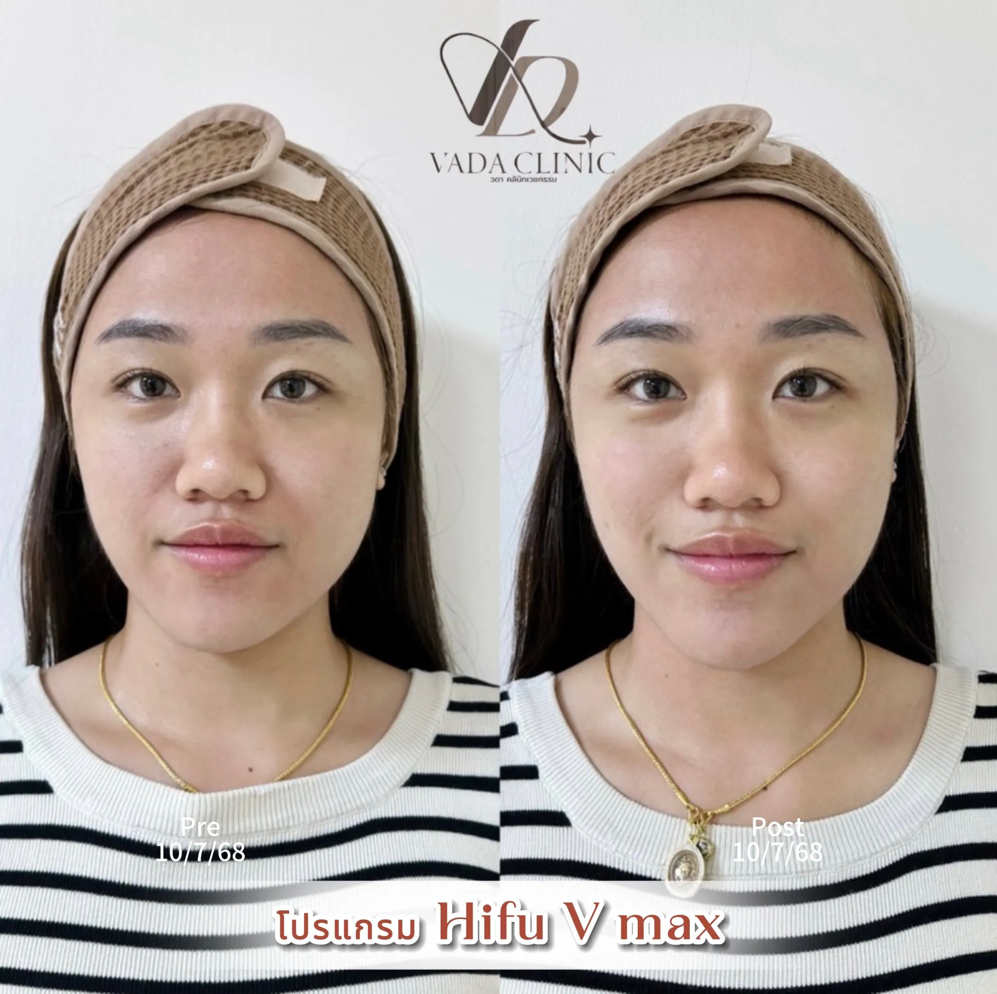 ผลลัพธ์การรักษาผิวหน้า Before After ผิวกระจ่างใส เรียบเนียน Vada Clinic บ้านฉาง ระยอง